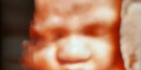RARO CASO DI ANEMIA FETALE A CHIETI: BIMBA SALVATA DA TRASFUSIONI IN UTERO